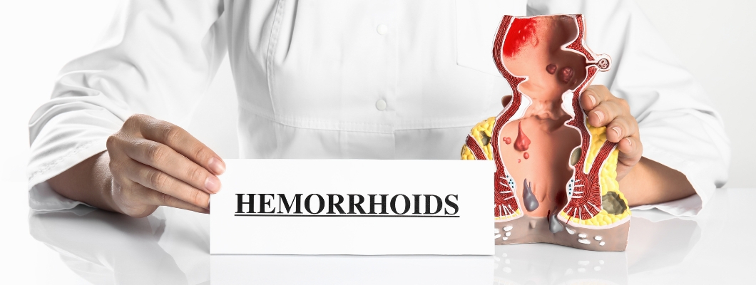 Äußere Hämorrhoiden – Ursachen, Symptome und Behandlung