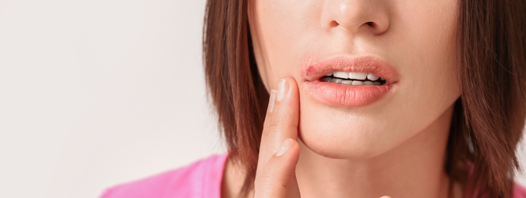 Lippenherpes: Wie man sie rechtzeitig erkennt und behandelt