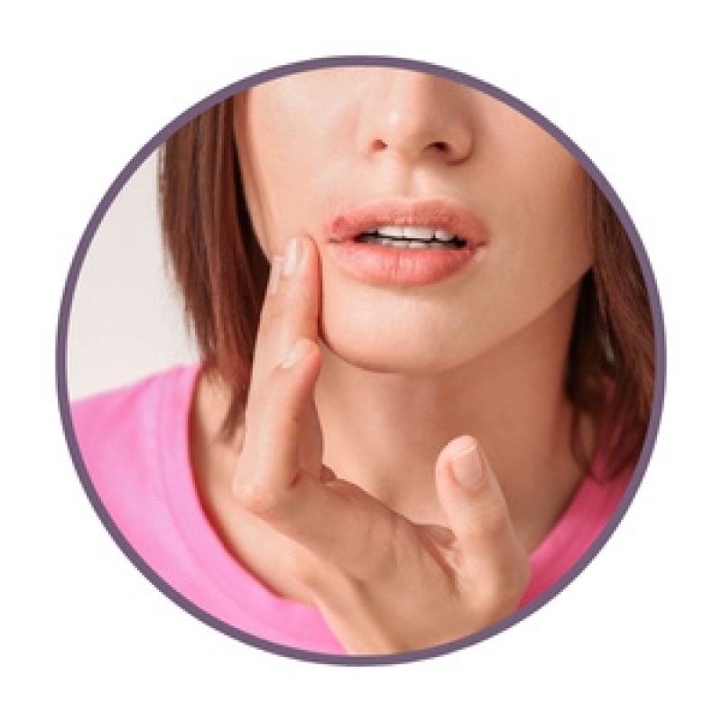 Salben bei lippenherpes