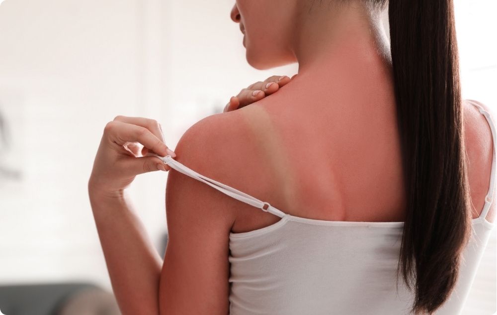 Als After-Sunbrand-Öl